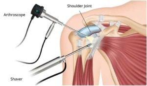Hip, Shoulder and Other Small Joint Procedures Driving US Arthroscope Device Market