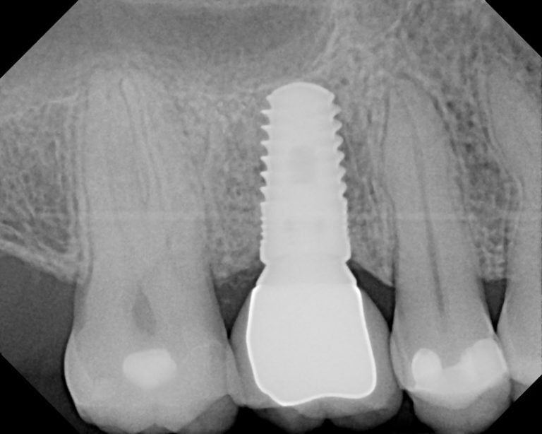Dental Biomaterials Market News iData Research