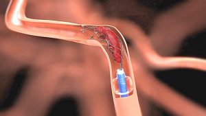 FDA Expands Treatment Window for Use of the Trevo Clot Retrieval Device In Certain Stroke Patients