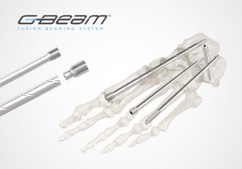Orthofix Receives FDA 510(k) Clearance of G-Beam Fusion Beaming System