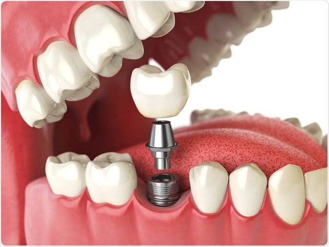 Digitization and Demographic Changes to Drive Growth in $3.2 Billion Chinese Dental Prosthetics Market