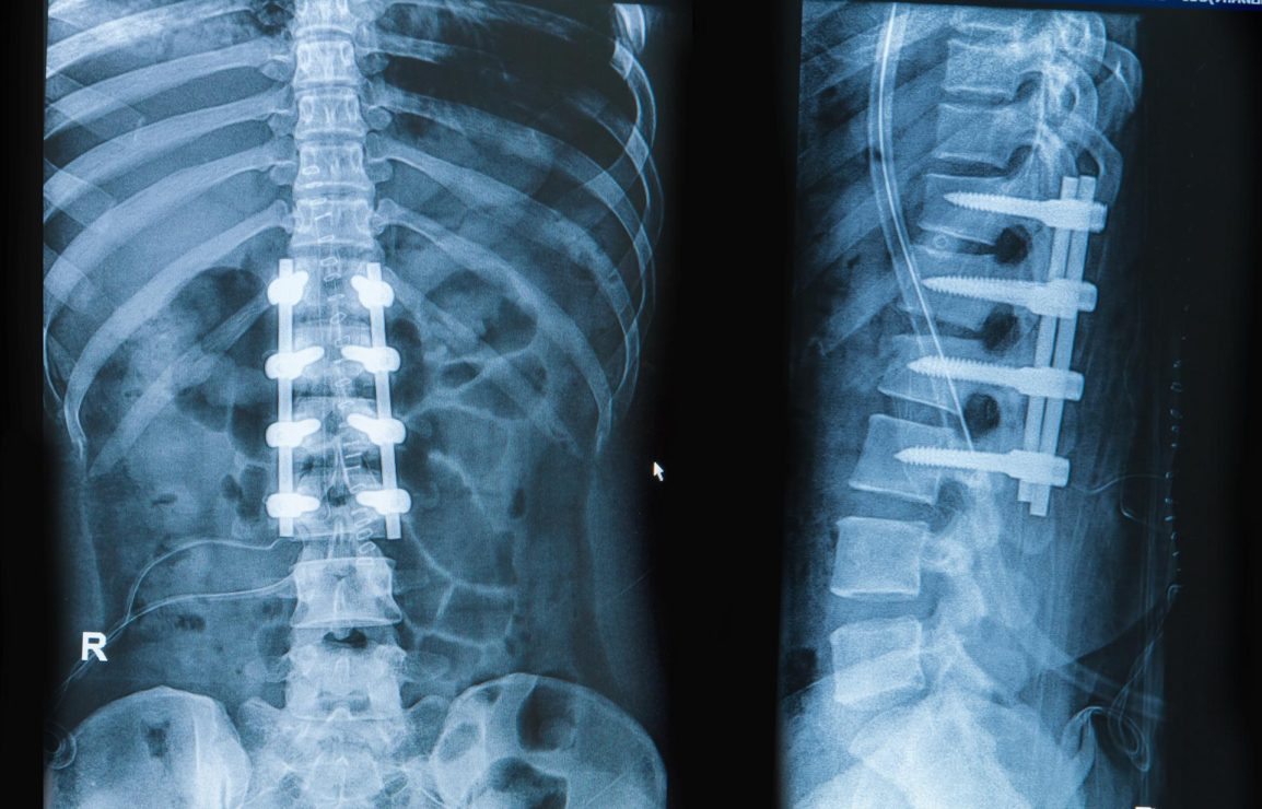 How Many Spinal Fusions are Performed Each Year in the United States?