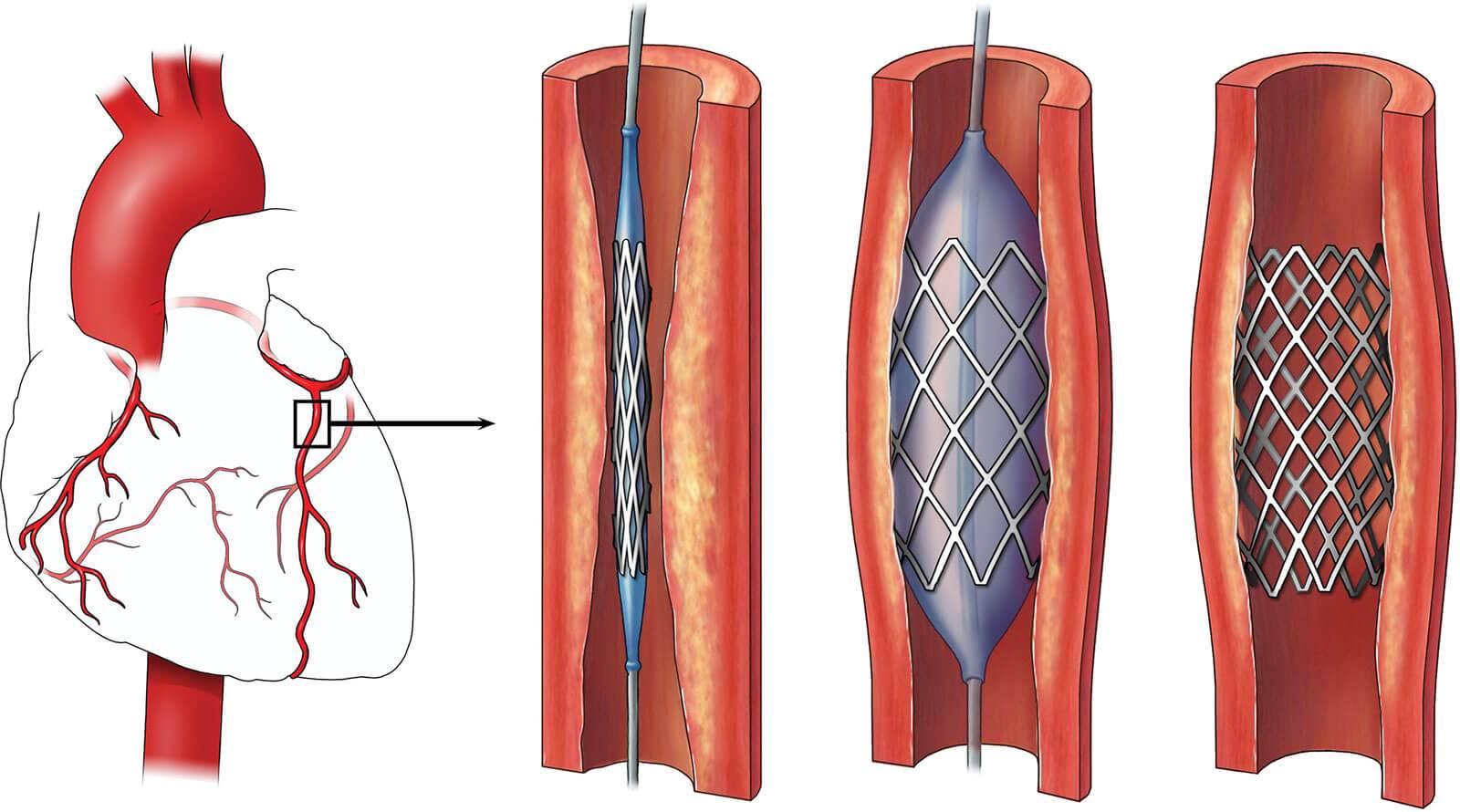 How Many Stents Can A Person Have 2020? - PostureInfoHub