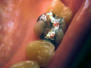 Researchers Develop Longer-Lasting Dental Fillings