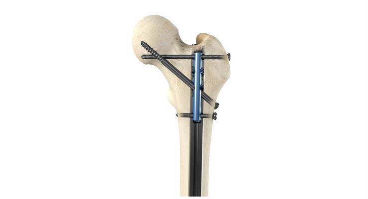 OrthoXel™ Announces Early Healing Using Apex Nailing System