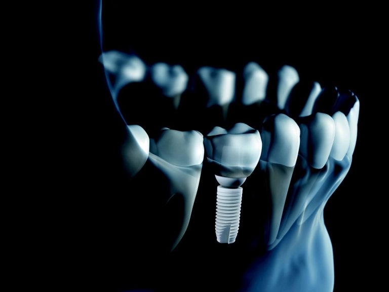 Straumann Partners with ZSystems for Ceramic Implant Distribution