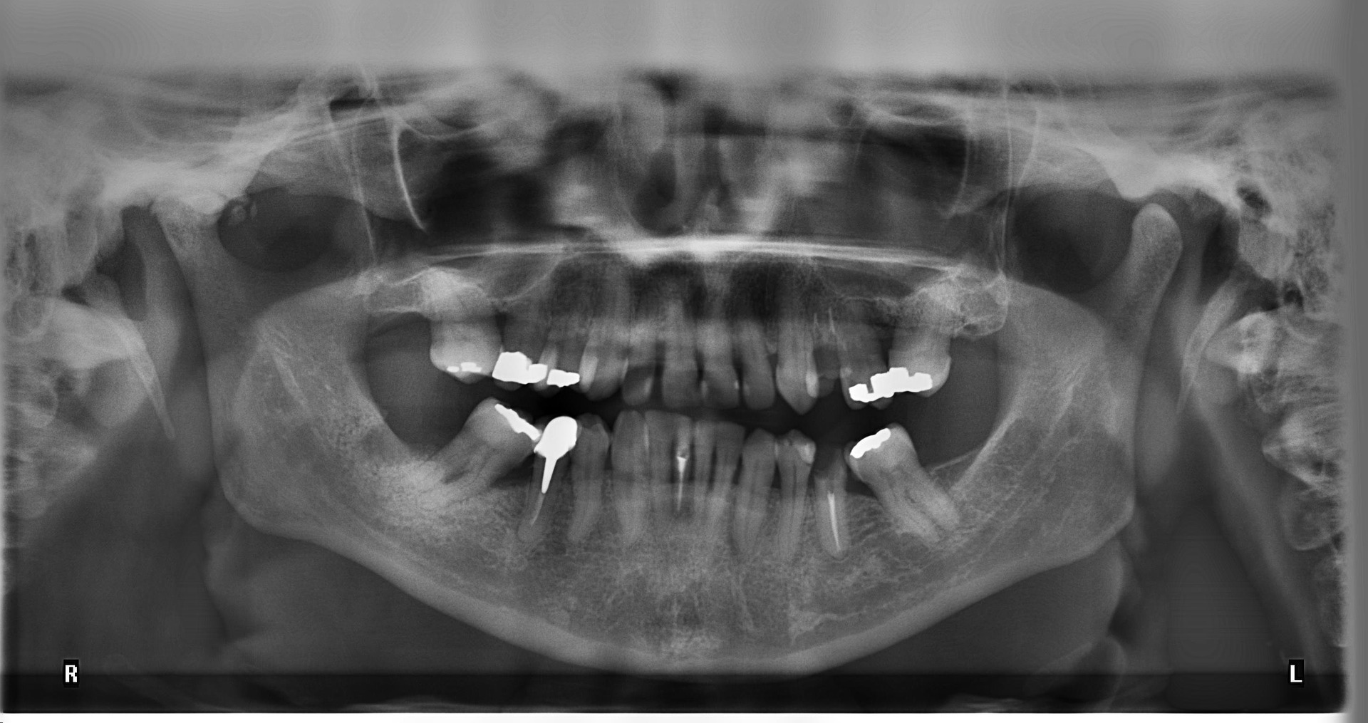 How Many Dental X-Rays are Performed in the United States?