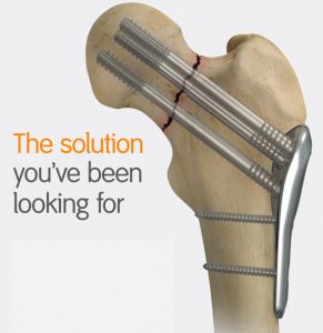 Smith & Nephew Launches the CONQUEST FN™ Femoral Neck Fracture System