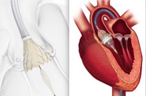 FDA Approves TAVR Systems to Younger, Low-Risk Heart Patients