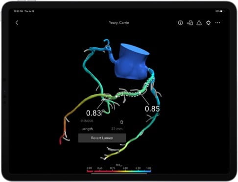 HeartFlow Planner Approved by FDA