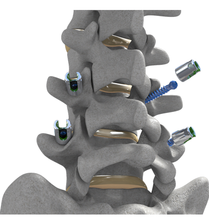DeGen Medicals Minimally Invasive Surgical Procedure