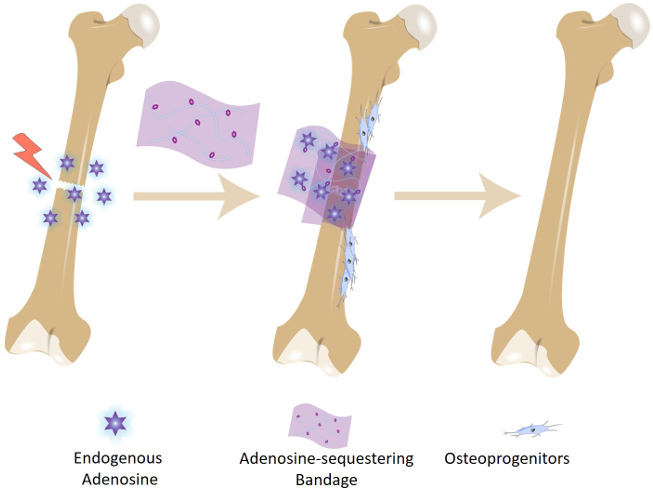 Adenosine-Sequestering Bone Bandage Accelerates Bone Repair