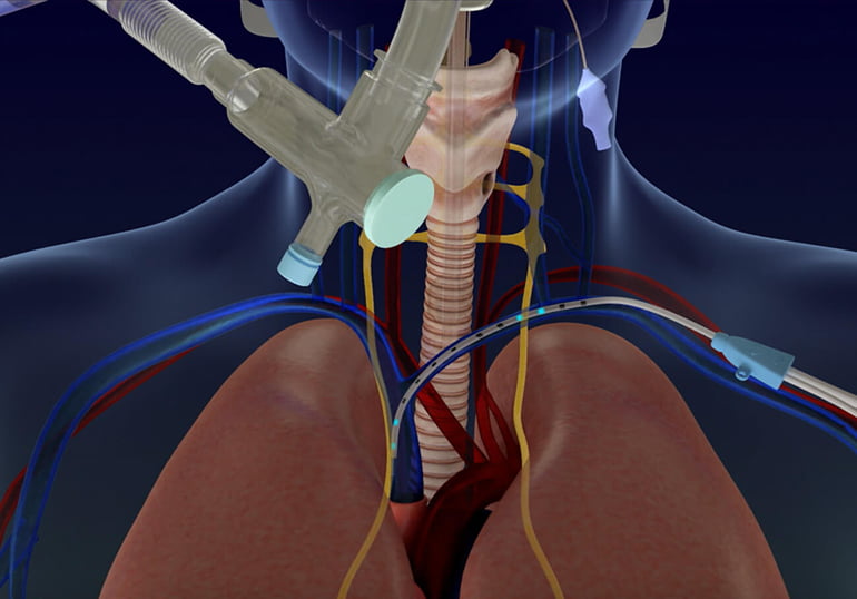 Lungpacer Medical Gains FDA Approval for Diaphragm Pacer
