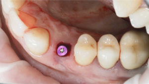 New Nanotechnology may Reduce Dental Implant Failure