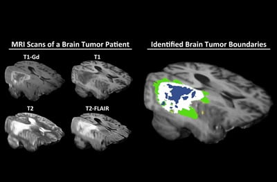 New Artificial Intelligence Data Analysis Preserves Patient Privacy