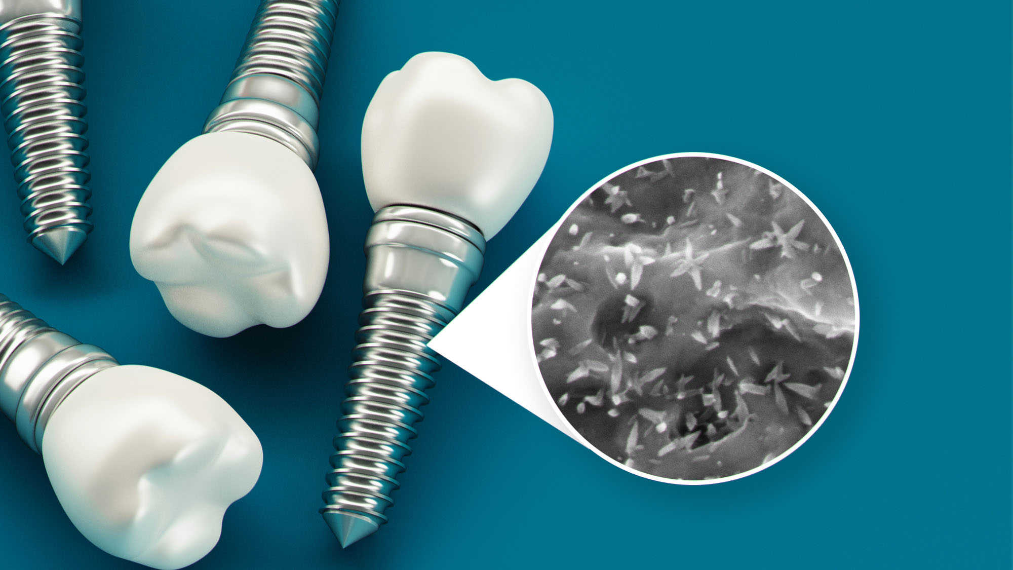 Nanodentistry Revolutionizing The Dental Implants Market