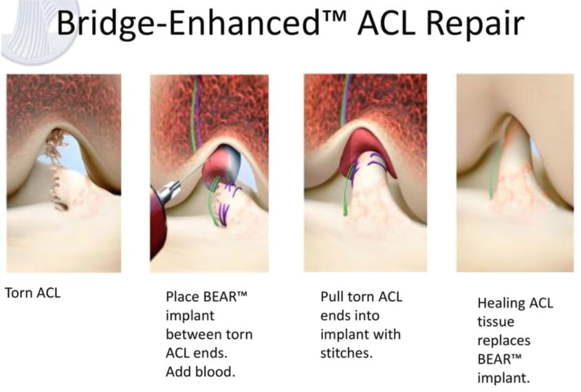 Breakthrough FDA Approval for ACL Tears to be Healed Instead of Being Rebuilt