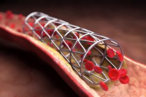 Best Coronary Stents from the Top Brands