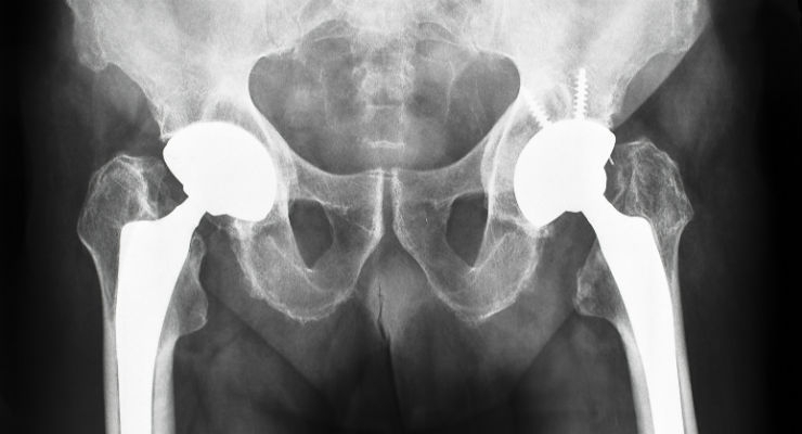 Cementless Hip | iData Research