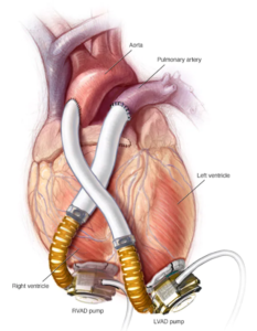 Everything You Need to Know About the Global Ventricular Assist Device and Intra-aortic Balloon Pump Markets