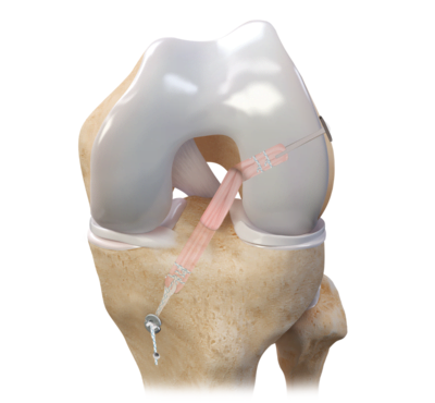 Growth in Sports Medicine Procedures Provides a Combined 70% Market Share to Arthrex, Smith and Nephew, and DePuy Synthes in the United States