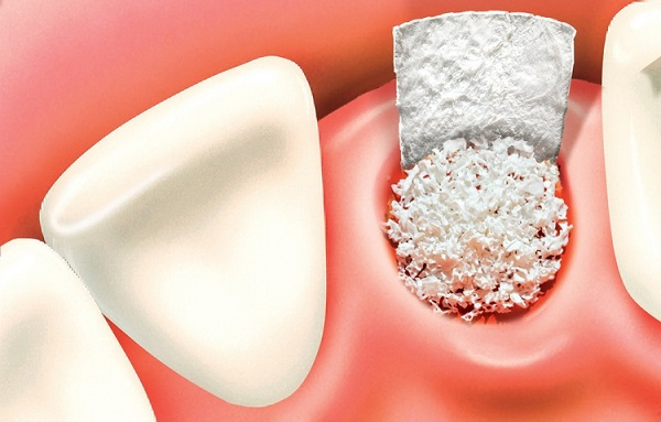 What Will the Dental Bone Graft Substitute (DBGS) Market look like in 6 Years?