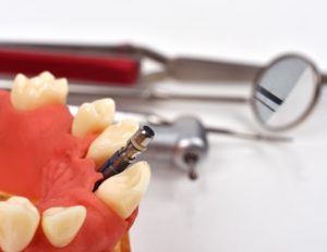 3 Questions about the U.S. Dental Implants and Bone Graft Substitutes Market You Need to Know the Answers To