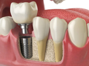 Your 2 Minute Guide to the Global Dental Bone Graft Substitute Market