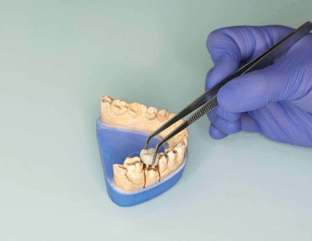 U.S. dental prosthetics