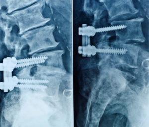 Trends Limiting and Driving the MIS Spinal Implants Markets In Mexico, Brazil, and Argentina