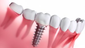 Asia Pacific’s Elderly Population Growth Results in Rise in Dental Implant and Abutment Market