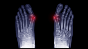 DePuy Synthes Strengthens Foot & Ankle Portfolio, Acquires CrossRoads