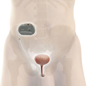 UroMems stress urinary incontinence