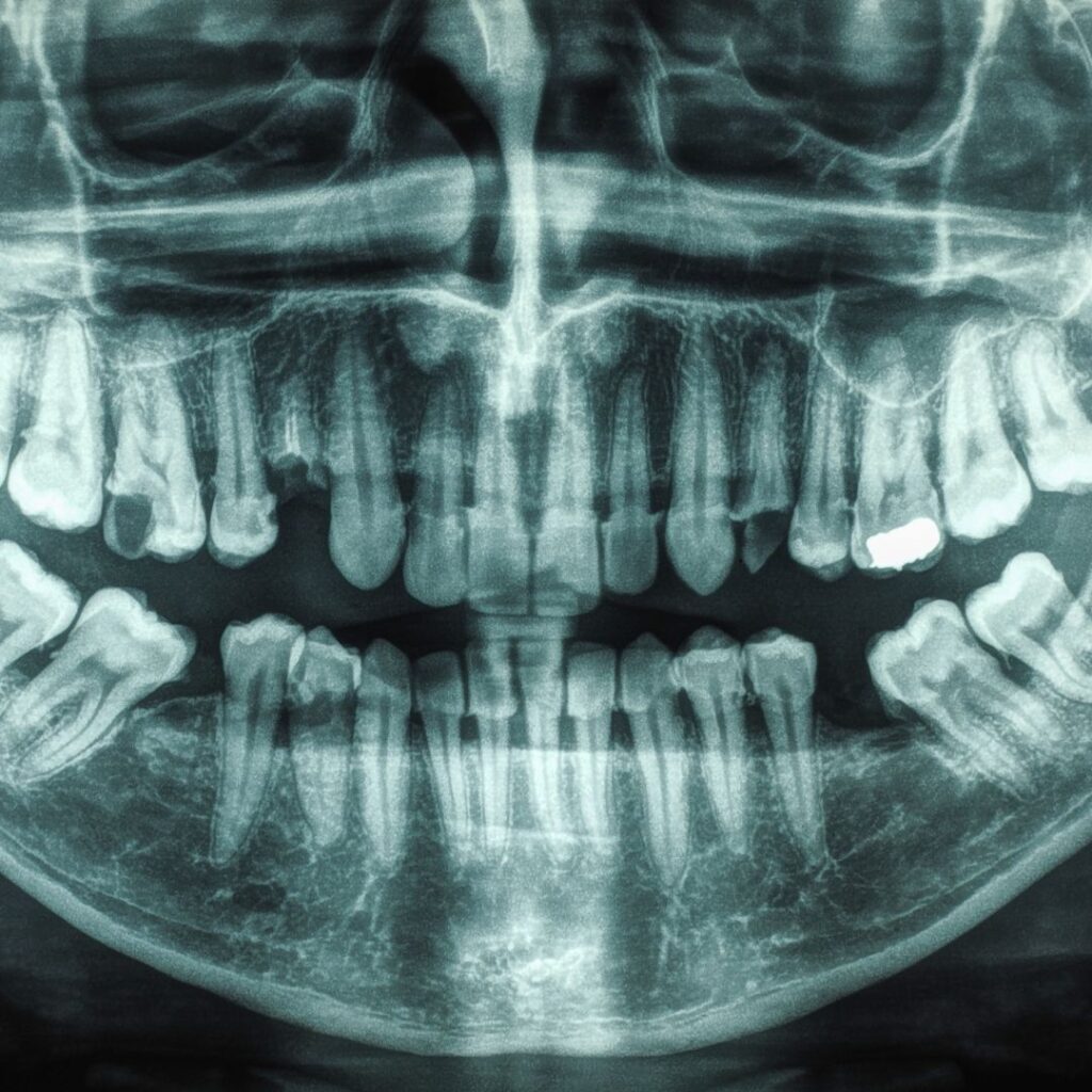 U.s. dental bone graft
