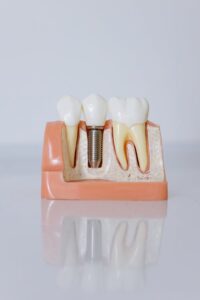 Exploring the Driving Forces Fueling Consistent Growth in the U.S. Dental Implant Market