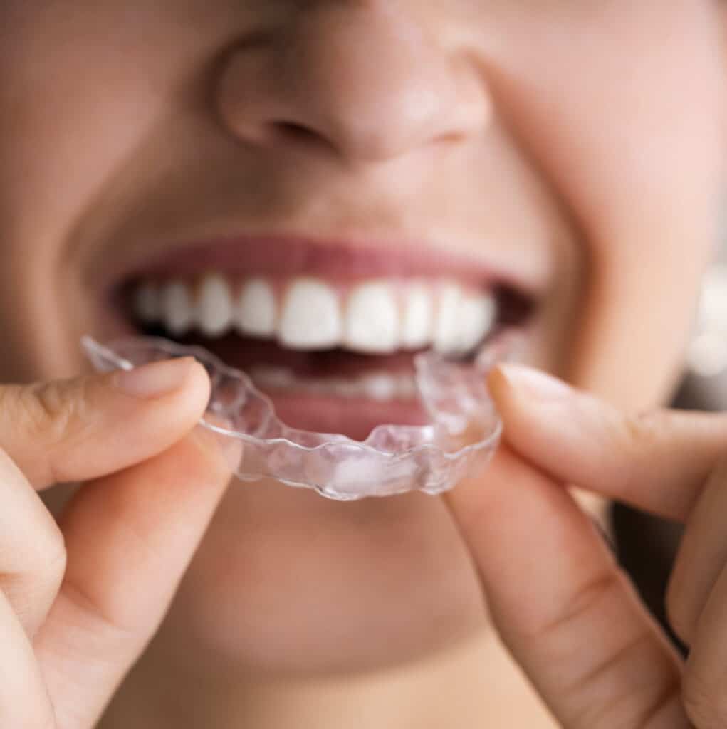 Clear aligners