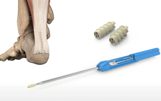 A Closer Look at Suture Anchors in the Global Orthopedic Soft Tissue Repair Market