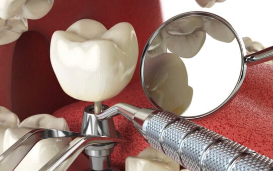 A Closer Look at the 2023 Developments in the European Dental Implant Market