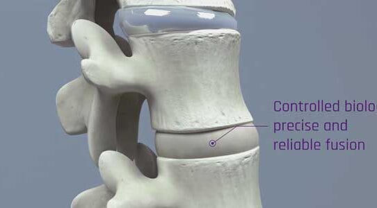 Renovos Attains FDA Breakthrough Device Designation for RENOVITE® BMP-2