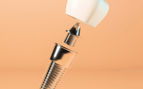 Top Developments in the Dental Implant Market