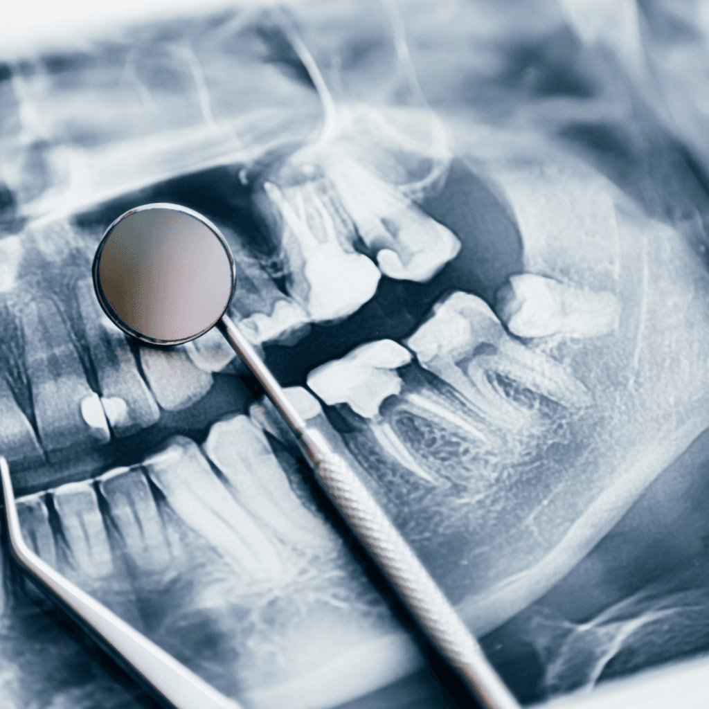 U.S. dental bone graft leaders