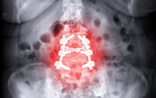 What Was the Most Popular MIS Spinal Implant Procedure in the US in 2023?
