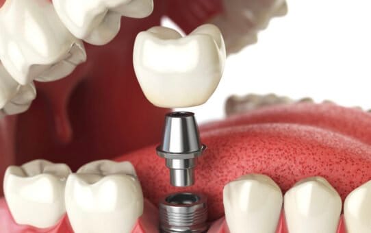 Top 3 Market Share Leaders in the Global Dental Implant Market