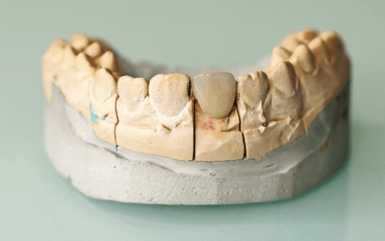 Top Market Drivers in the Global Dental Prosthetics Market