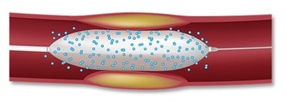 Narkotikų dengtos balionai
