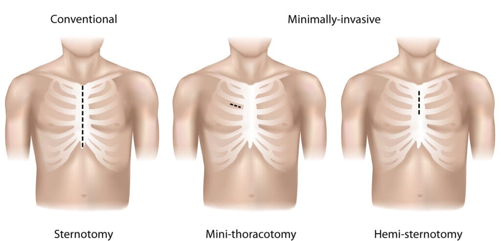 Minimaliai invazinė širdies chirurgija Nauja era