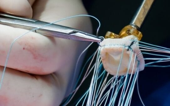 Minimally Invasive Heart Surgery: Can TAVI & TMVr Replace Open Surgery for Good?