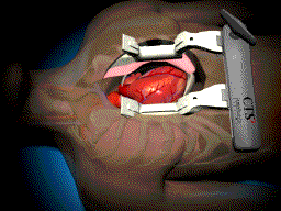 Kas yra atvira širdies operacija