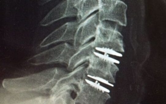 Artificial Disc Replacement: Why Cervical Is Thriving While Lumbar Lags Behind