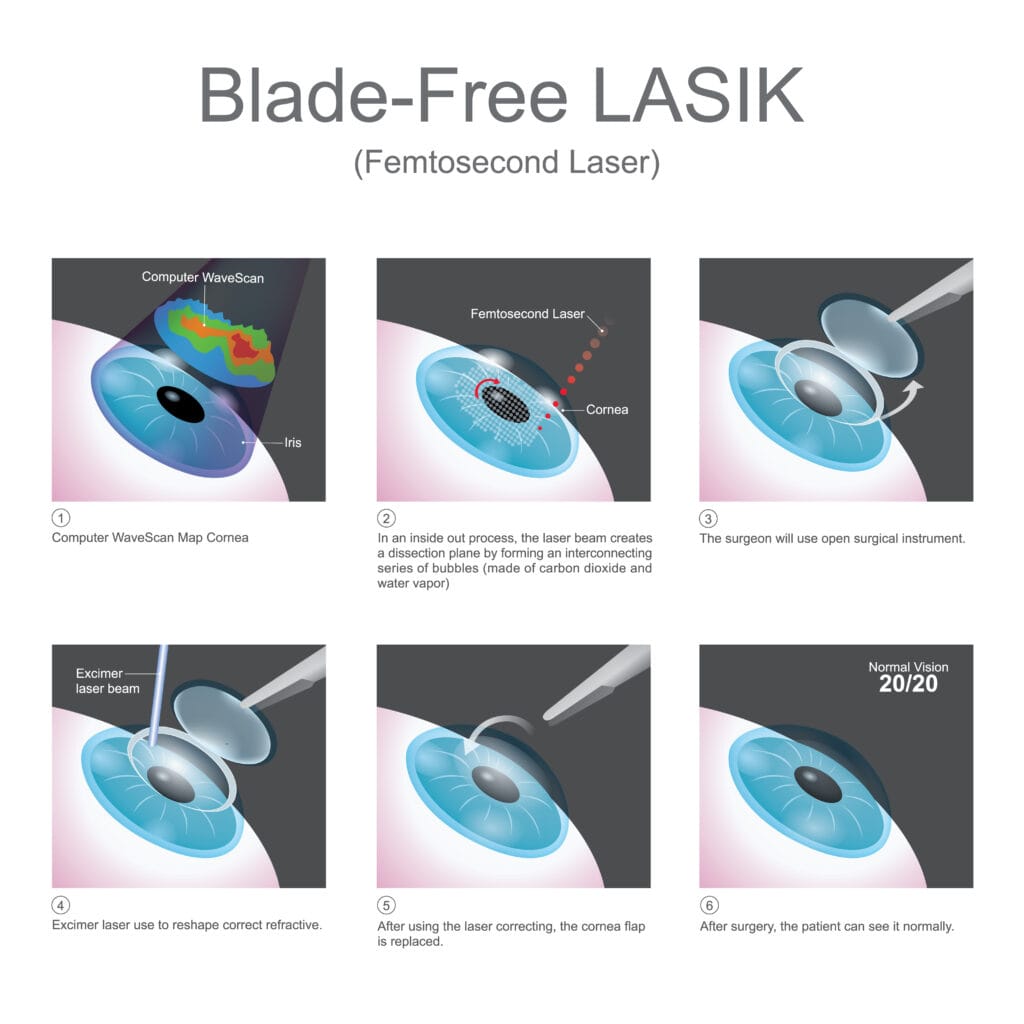 Kas yra „Advanced Lasik“ (valdoma topografija arba femtosekundės lasik)